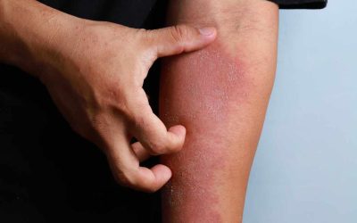 Demystifying Dermatitis: Understanding Inflammation as the Root Cause