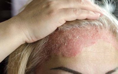 What Is Dermatitis?