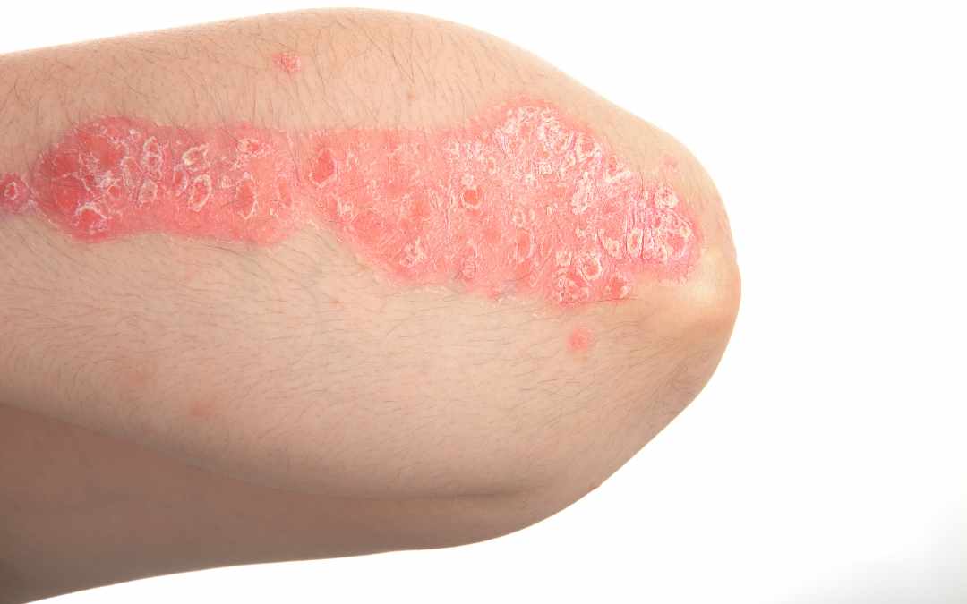 Medical Treatments for Dermatitis